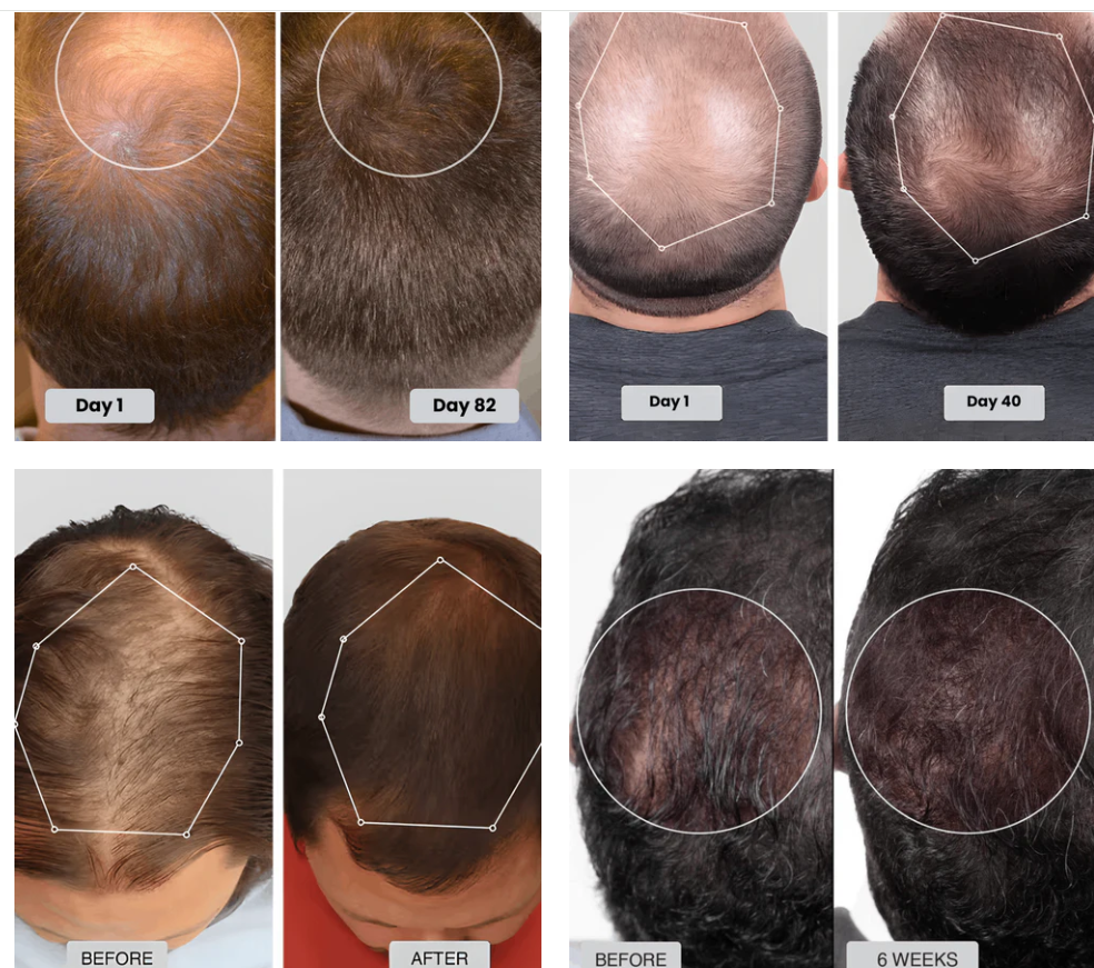 Red Light Therapy Cap for Hair Regrowth Treatments